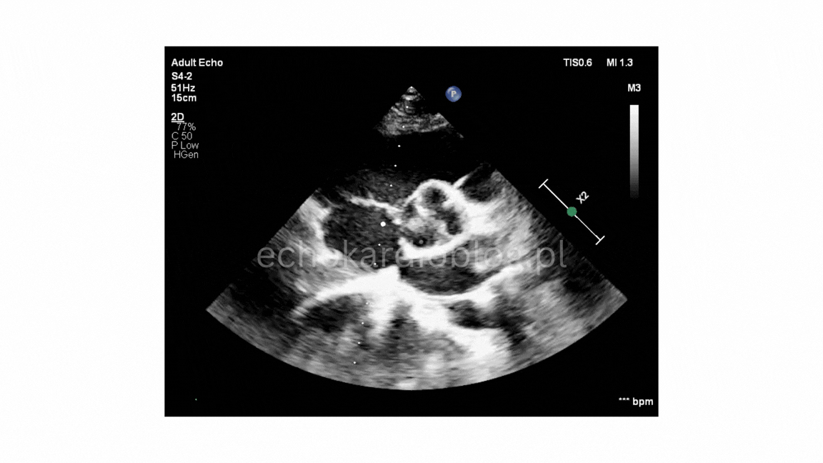 Zastawka aortalna dwupłatkowa echo 